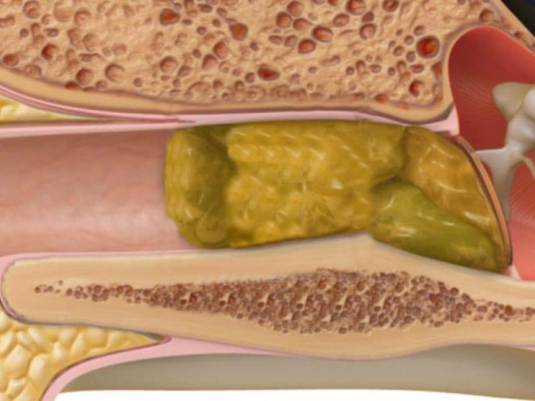 Κερί στο αυτί: Tι να προσέξετε
