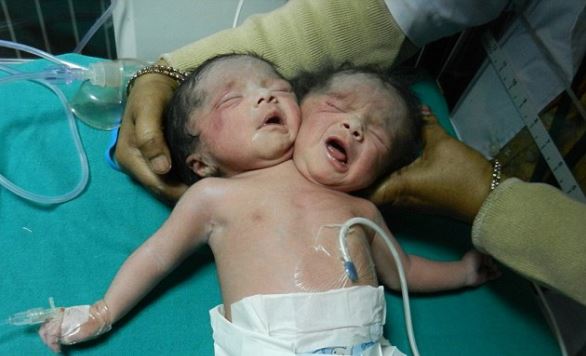 ΦΩΤΟ-Γεννήθηκε μωρό με δύο κεφάλια