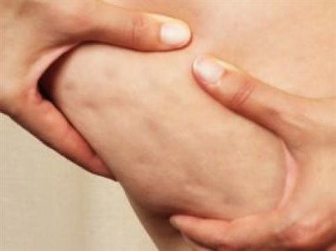 Πώς να εξαφανίσετε την κυτταρίτιδα