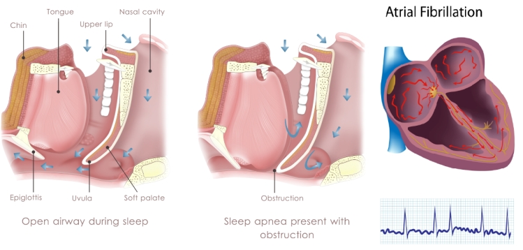 Η αποφρακτική υπνική άπνοια σχετίζεται με την κολπική μαρμαρυγή