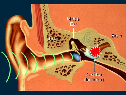 Η πρώτη γονιδιακή θεραπεία της ακοής