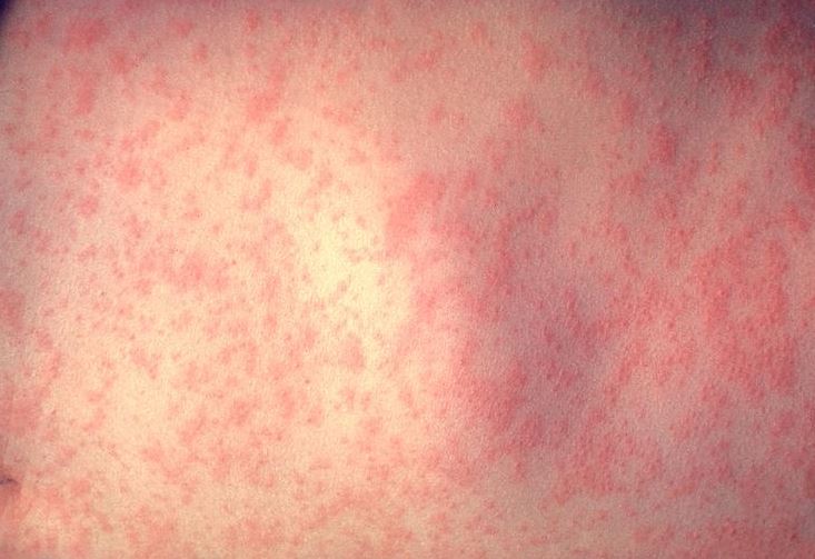 Βιετνάμ-Πάνω από 100 παιδιά νεκρά από ιλαρά