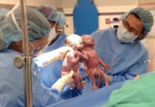 ΒΙΝΤΕΟ-Τα μονοζυγωτικά δίδυμα που κρατιούνται χέρι χέρι