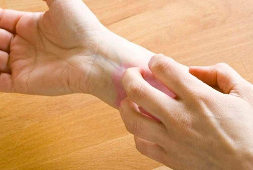 Το έκζεμα “προστατεύει” από τον καρκίνο του δέρματος