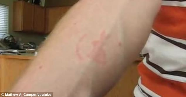 ΒΙΝΤΕΟ-Έκανε τατουάζ με …κοριούς