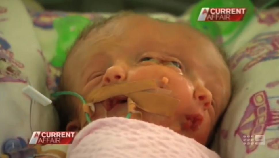 ΦΩΤΟ-Γεννήθηκαν σιαμαία με ένα σώμα και δύο εγκεφάλους