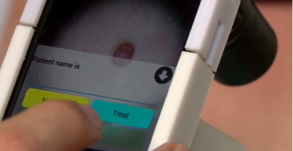 Smartphone συσκευή εντοπίζει τον καρκίνο