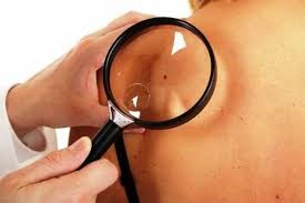 Ελπιδοφόρα νέα για τους ασθενείς με μελάνωμα