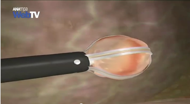 ΒΙΝΤΕΟ-Νέα αναίμακτη βιοψία μαστού