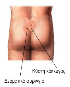 Άμεση και εντελώς ανώδυνη θεραπεία της κύστης κόκκυγα με laser