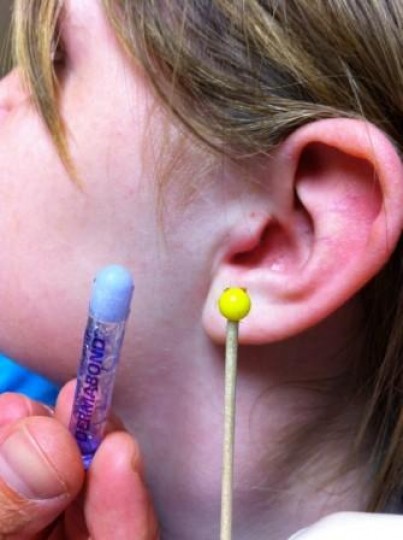 Τραύματα και ξένα σώματα ακουστικού πόρου