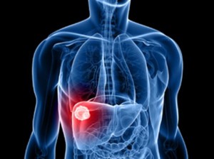 Ηπατοκυτταρικό καρκίνωμα: Διάγνωση και θεραπεία