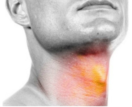 Φαρυγγο-λαρυγγική παλινδρόμηση: Γιατί έχω καούρες;