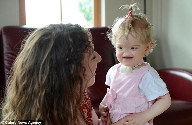 ΦΩΤΟ-Kοριτσάκι γεννήθηκε χωρίς μύτη