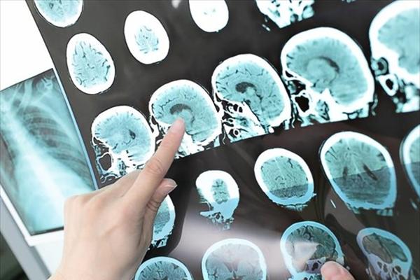 Μειώθηκαν τα εγκεφαλικά τις δυο τελευταίες δεκαετίες