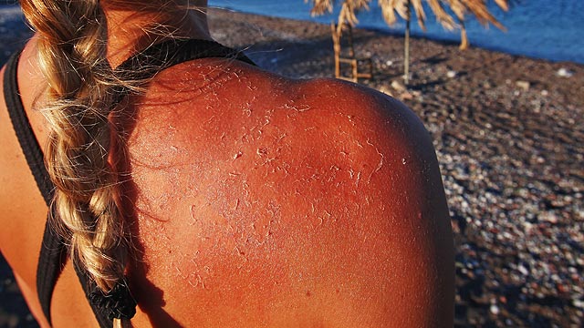 Προστατεύστε και θεραπεύστε το ηλιοκαμένο δέρμα