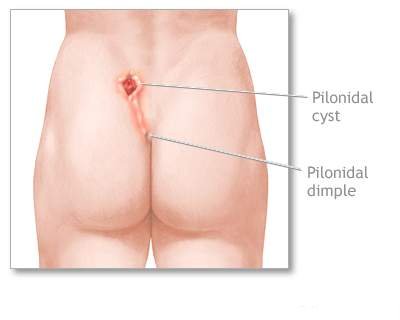 Κύστη Κόκκυγος: Σύγχρονη, ανώδυνη και αποτελεσματική θεραπεία