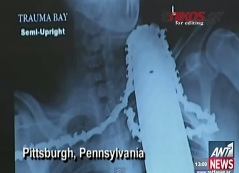 ΒΙΝΤΕΟ-Αλυσοπρίονο καρφώθηκε στο λαιμό ξυλοκόπου