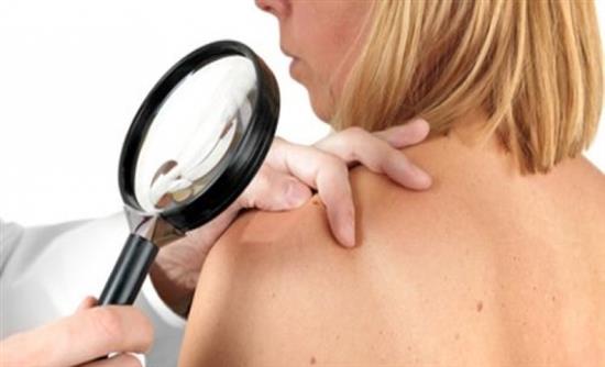 Κρίσιμες οι ηλικίες 15-20 ετών για το μελάνωμα