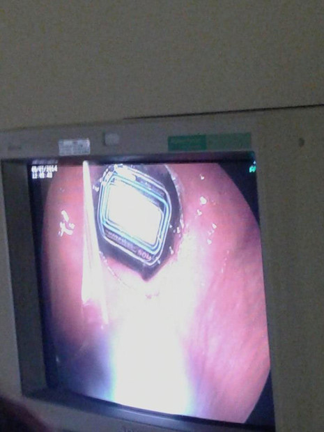 Aφαίρεσαν από το στομάχι κρατούμενου…ρολόι