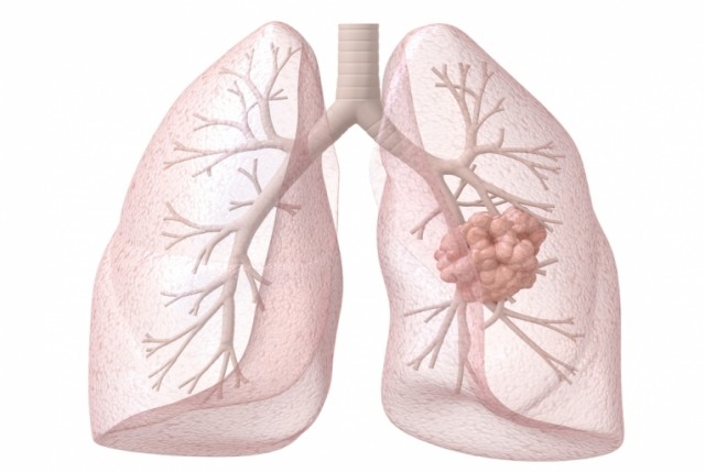 Καρκίνος του πνεύμονα-Τι τον προκαλεί και ποιοι κινδυνεύουν;