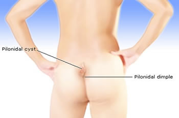 Κύστη κόκκυγος: Tέλος με ραδιοσυχνότητες