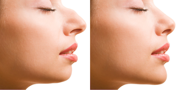 Δες πώς θα είναι η μύτη σου αν κάνεις πλαστική