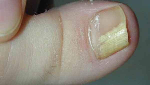 Μύκητες στα νύχια-Τι τους προκαλεί και πόσο επικίνδυνοι είναι
