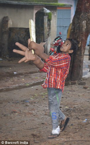 He has found it difficulty to play cricket and hold a bat due to his condition but tries to still join in with his friends