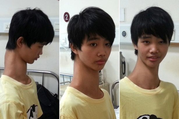 ΦΩΤΟ-15χρονος Κινέζος με ασυνήθιστα μακρύ λαιμό