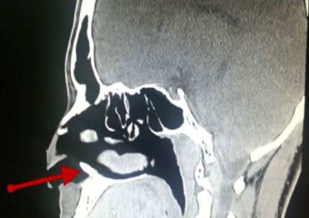 ΦΩΤΟ-«Φύτρωσε» δόντι στη μύτη του