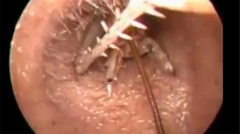 ΒΙΝΤΕΟ-Έντομο 7,5 εκατοστών στο αυτί ασθενούς