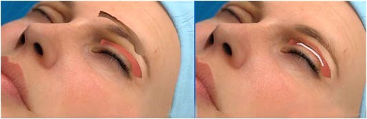 Εξαφανίστε οριστικά τις ρυτίδες από την περιοχή των ματιών