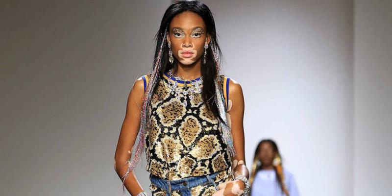 ΦΩΤΟ-Το περιζήτητο μοντέλο που έχει λεύκη