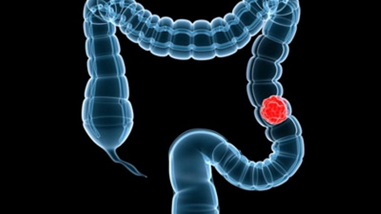 Σε αύξηση ο καρκίνος του εντέρου σε νέους
