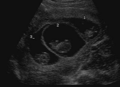 Σπάνια περίπτωση γέννησης τριδύμων με κοινό πλακούντα