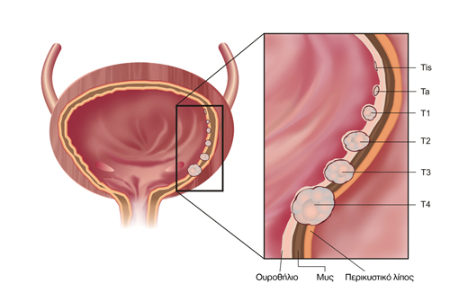 Έρευνα: Πρόοδος στην αντιμετώπιση του καρκίνου της ουροδόχου κύστης