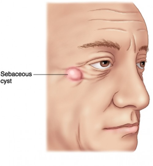 Σμηγματογόνος κύστη: Όσα πρέπει να γνωρίζετε