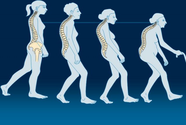 Ποιες τροφές εμποδίζουν την εμφάνιση της οστεοπόρωσης