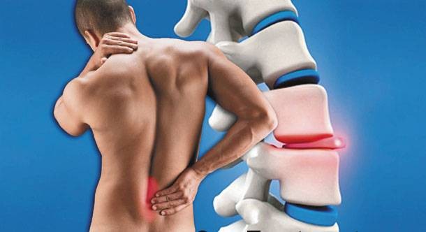 Κήλη μεσοσπονδύλιου δίσκου στη μέση