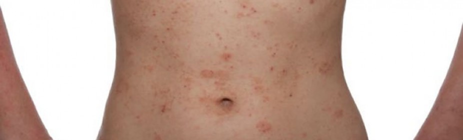 Το fast food “θρέφει” την ατοπική δερματίτιδα