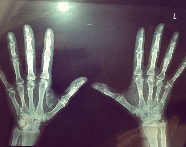 ΦΩΤΟ-Ποια παρουσιάστρια έβαλε την ακτινογραφία της στο instagram