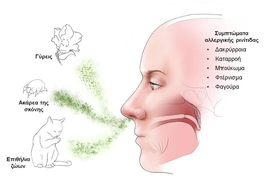 Αλλεργική ρινίτιδα σε παιδιά