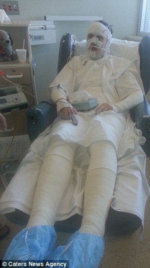 Miss Heron's entire body was bandaged up as her mouth fused shut and she lost the top layer of her skin on her face, chest, back and arms (left). She survived the ordeal and is now at home recovering (right)