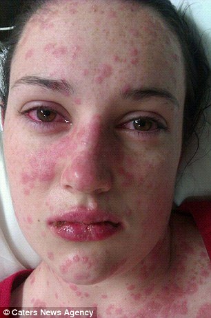 The conditions caused half the skin on her body to burn, scab and fall off (left). Her eyes and lips had swollen painfully (right), she couldn't breath her neck had swollen so much she couldn't even drink