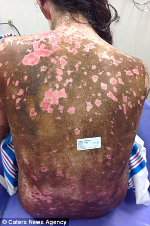 The conditions caused half the skin on her body to burn, scab and fall off (left). Her eyes and lips had swollen painfully (right), she couldn't breath her neck had swollen so much she couldn't even drink
