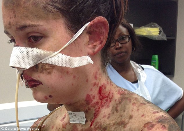 Miss Heron was struck down with Stevens Johnson Syndrome (SJS) and TENS - Toxic Epidermal Necrolysis Syndrome - which caused severe burns to her organs and skin