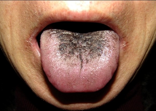 Τί μπορείς να μάθεις για την υγεία σου από το χρώμα της γλώσσας;