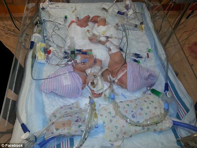 Σιαμαία δίδυμα γεννήθηκαν στη Φλόριντα – ΦΩΤΟ