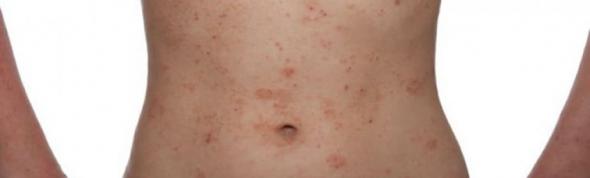 Το fast food “θρέφει” την ατοπική δερματίτιδα